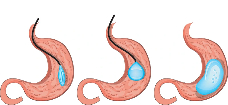Gastric Balloon Success Rates and Weight Loss Outcomes