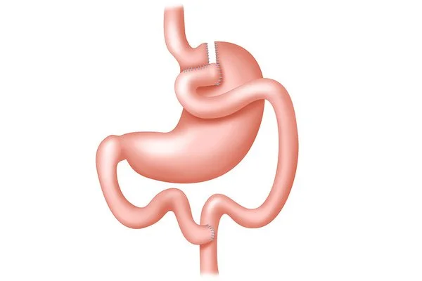 Gastric Bypass Reversal: Procedures, Reasons and Recovery