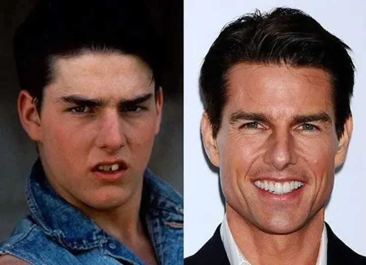 Tom Cruise’s Teeth: Alignment, Braces, and Veneer Transformation
