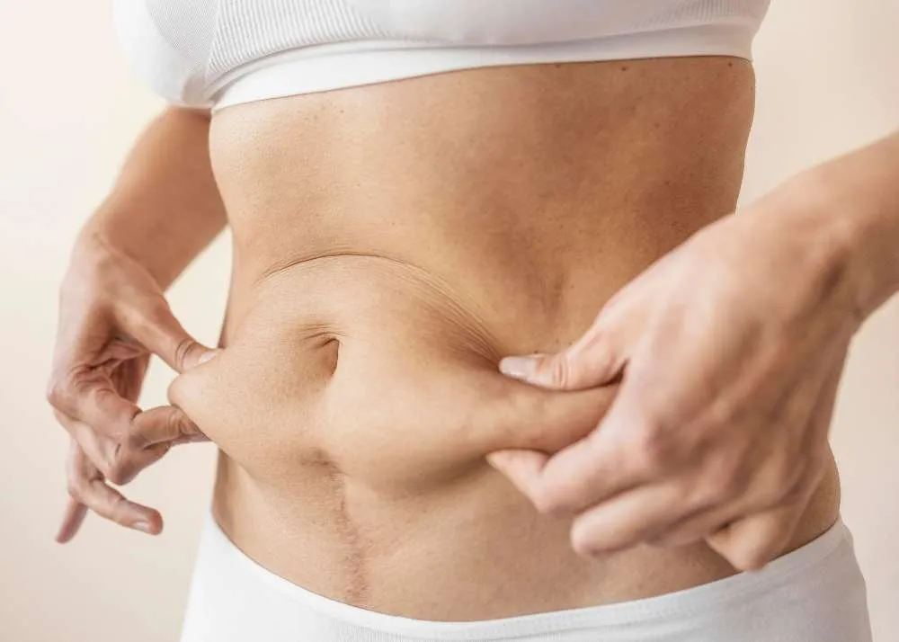 Tummy Tuck After Weight Loss Surgery: Timing and Options