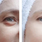 Blepharoplasty Recovery Timeline