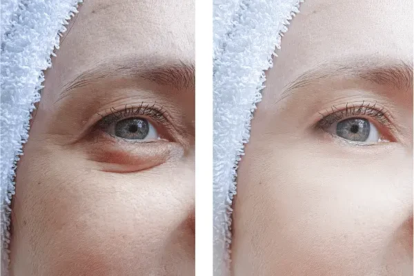 Blepharoplasty Recovery Timeline