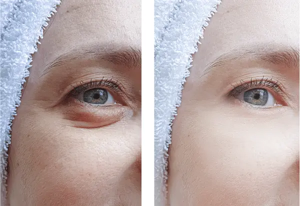 Blepharoplasty Recovery Timeline