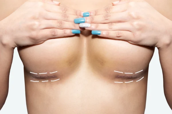 Breast Reduction Scars