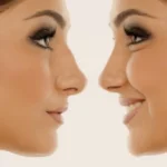 Non-Surgical Wide Nose Correction