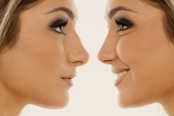 Non-Surgical Wide Nose Correction