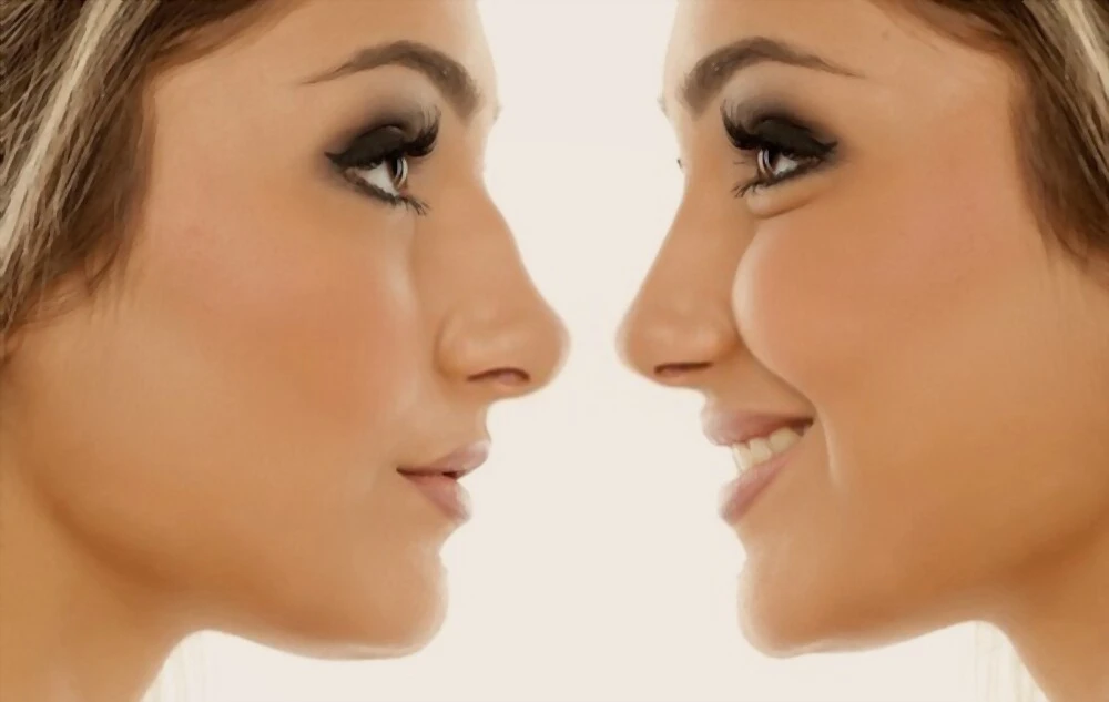 Non-Surgical Wide Nose Correction