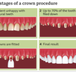 Teeth Shaving for Veneers