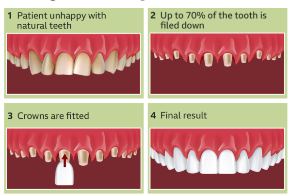 Teeth Shaving for Veneers