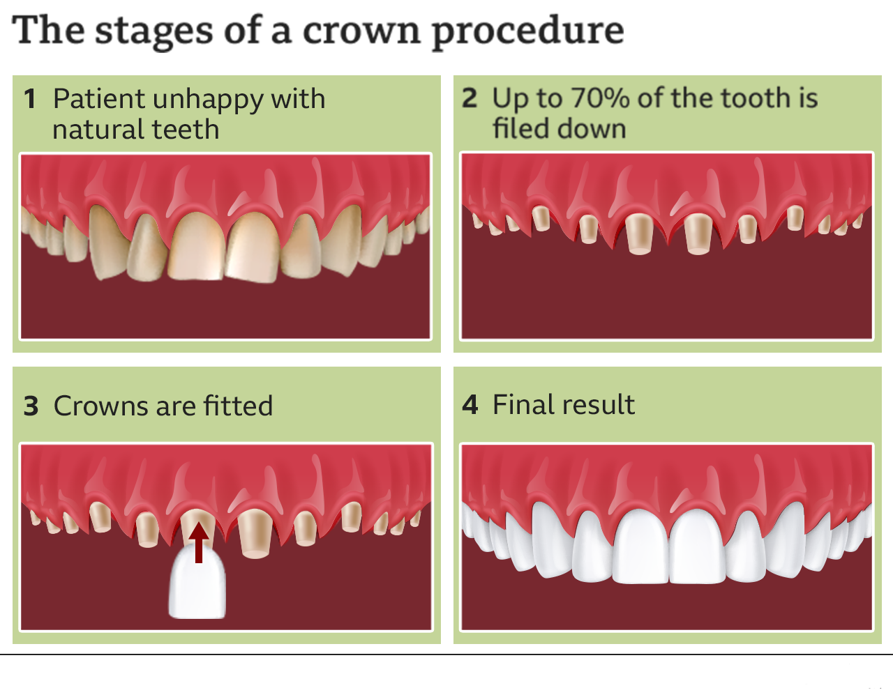 Teeth Shaving for Veneers