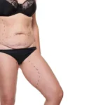 Tummy Tuck After Weight Loss Surgery