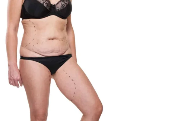 Tummy Tuck After Weight Loss Surgery