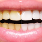 Yellow Teeth Causes, Patterns and Whitening Solutions