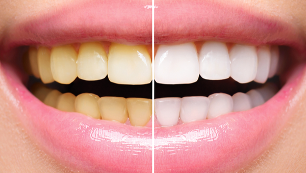 Yellow Teeth Causes, Patterns and Whitening Solutions