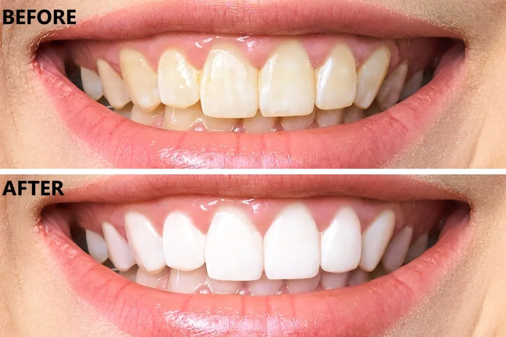 Laser Teeth Whitening: Results, Costs, and What to Expect