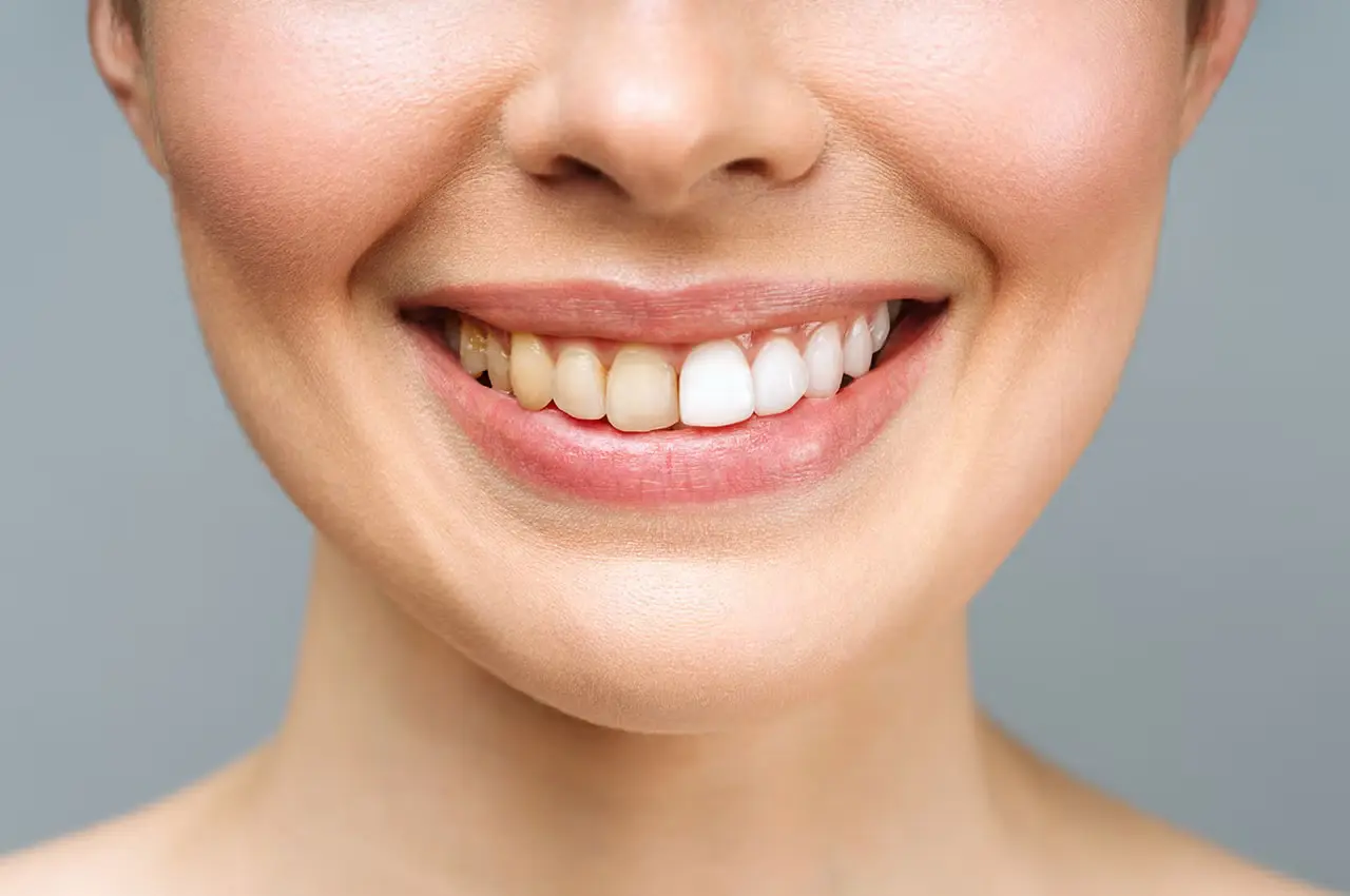 Why Molars Change Color: Causes, Types and Treatment Options