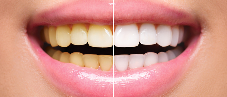 Yellow Teeth Causes, Patterns and Whitening Solutions