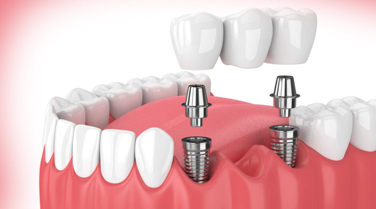 Dental Bridges in Turkey: Expert Insights
