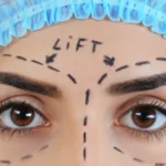 Endoscopic Brow Lift: Precision Rejuvenation Unveiled
