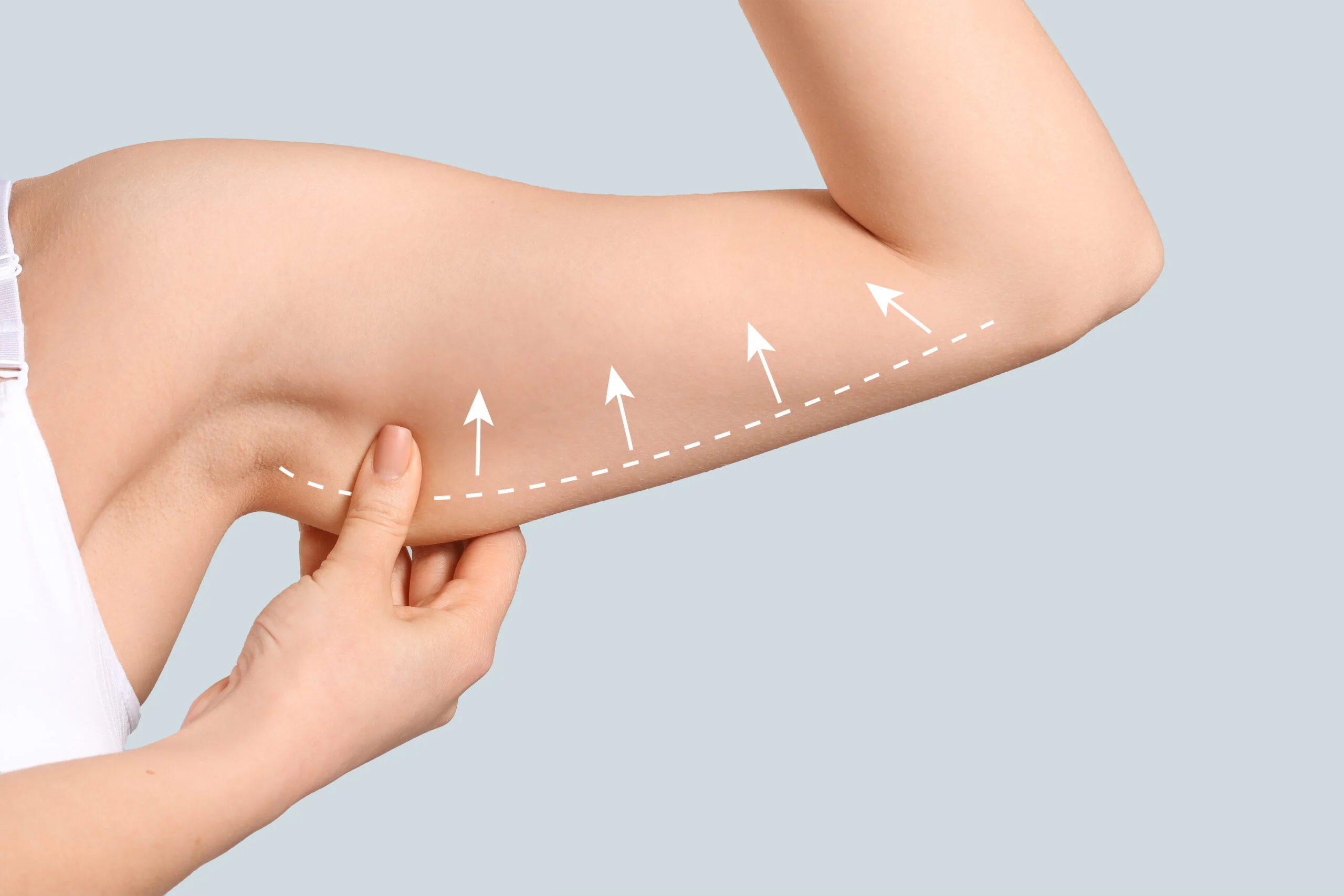 Post-Bariatric Arm Lift: Your Guide to Toned Arms in Turkey