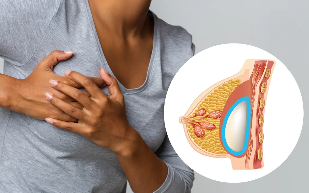 Capsular Contracture