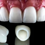 Emax Veneers Before and After Results