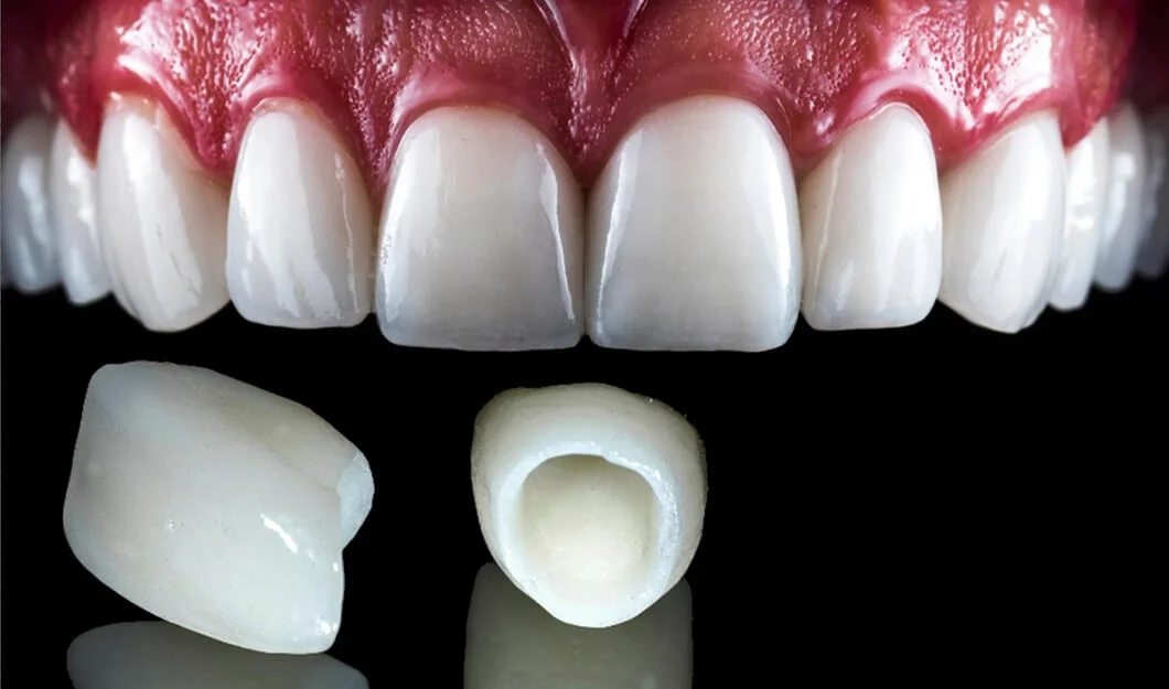Emax Veneers Before and After Results