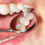 Restorative Dentistry: Dental Fillings Explored in Turkey
