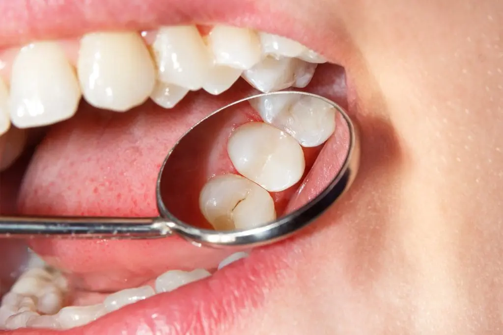 Restorative Dentistry: Dental Fillings Explored in Turkey