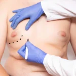 Male Breast Reduction Reviews