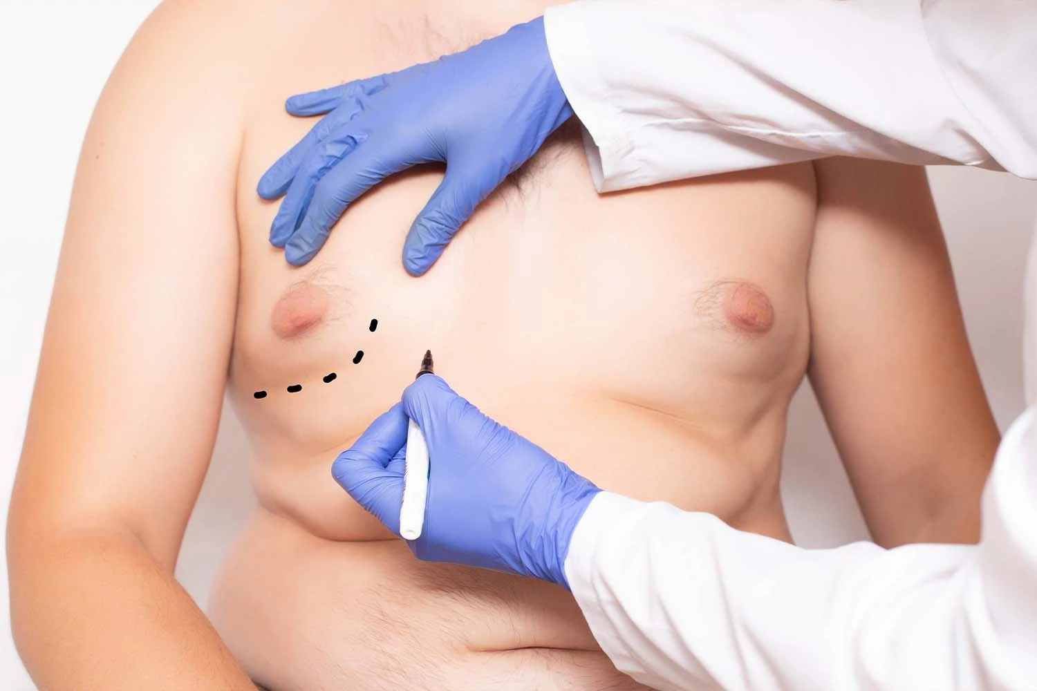 Male Breast Reduction Reviews
