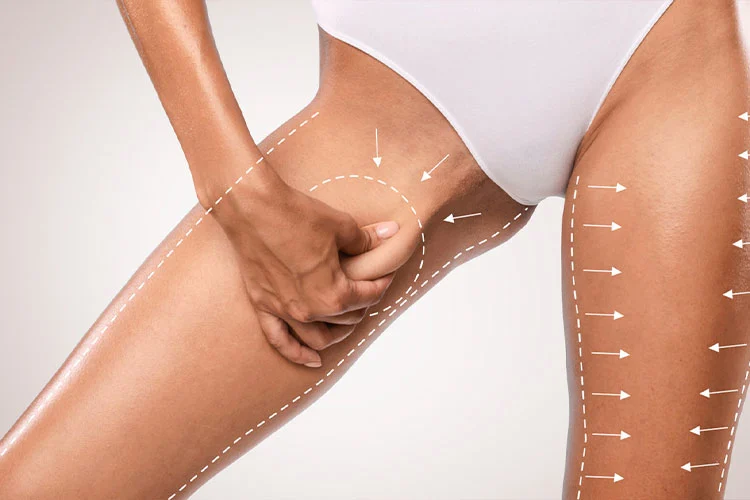 Inner Thigh Lift Surgery: Definitive Guide