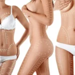 Mommy Makeover Abroad Options