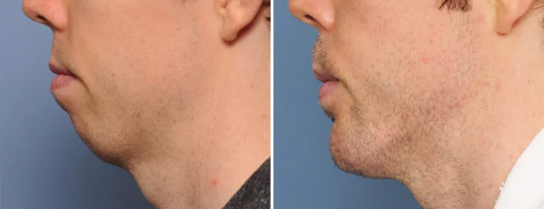 Genioplasty vs Chin Implant: A Deep Dive