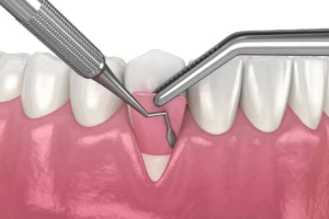Gum Grafting: Essential Periodontal Health