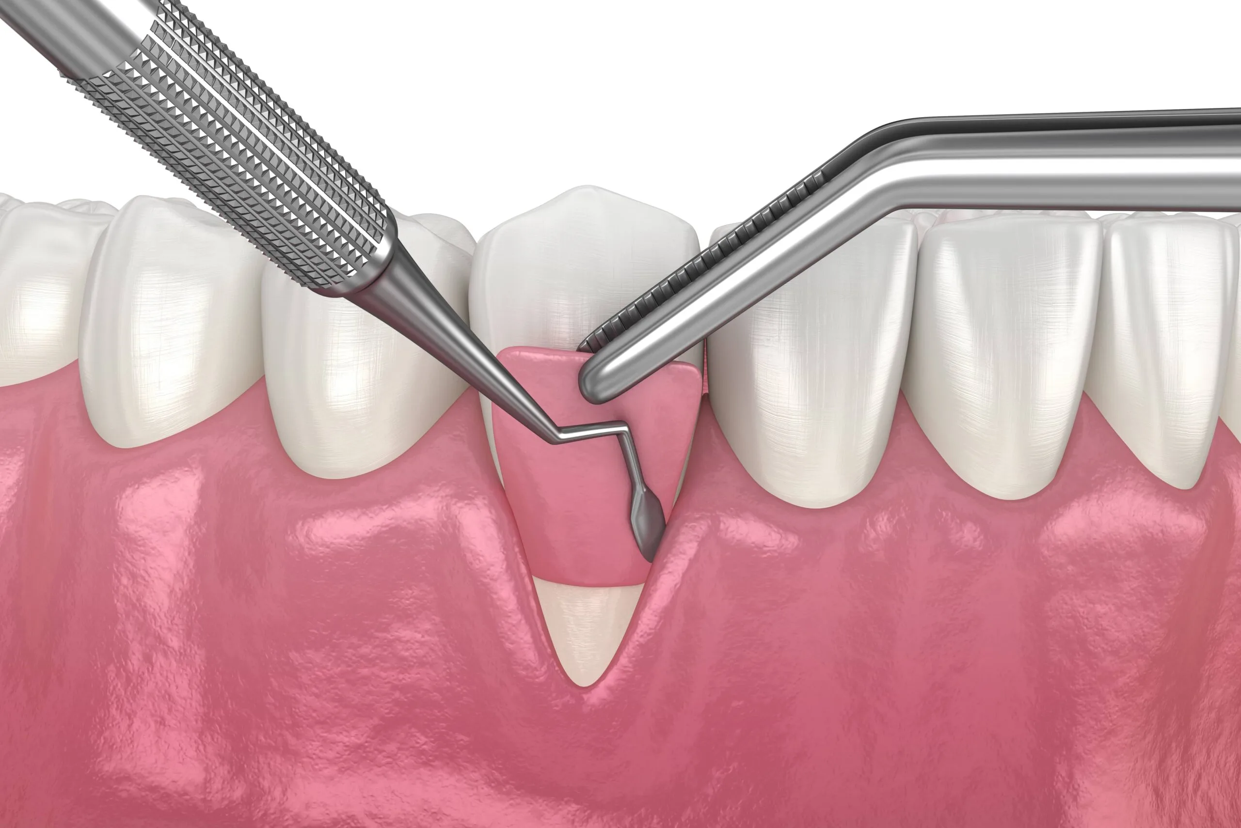 Gum Grafting: Essential Periodontal Health