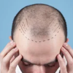 Hair Transplant Recovery: Comprehensive Healing Timeline
