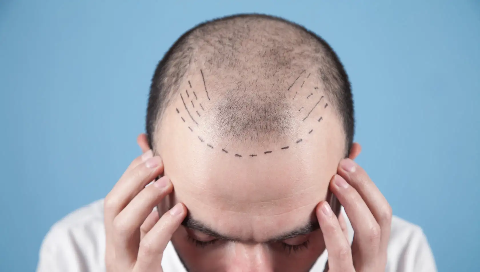 Hair Transplant Recovery: Comprehensive Healing Timeline