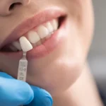 Perfecting Smiles: The World of Laminate Veneers
