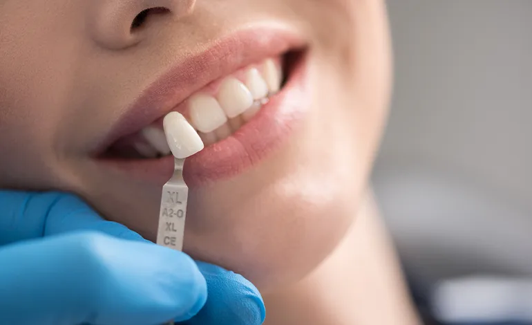Perfecting Smiles: The World of Laminate Veneers