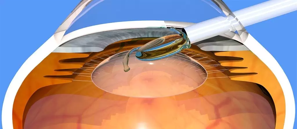 Implantable Collamer Lenses (ICL): Advanced Vision Correction