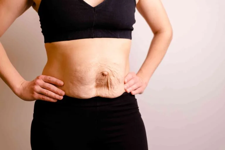 Ozempic Skin: Managing Post-Weight Loss Laxity