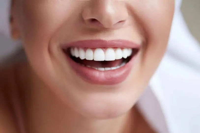 Premium Veneers: Understanding Turkey Costs