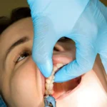 Oral Surgery Recovery: Stitch Removal Steps