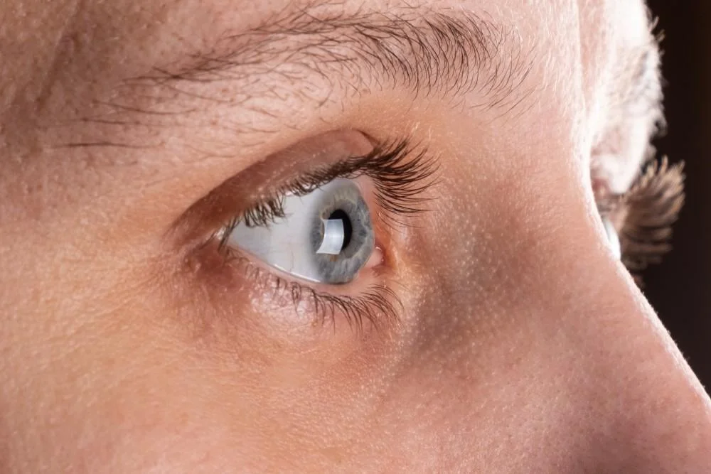 Why Would Someone Need a Cornea Transplant: Indications Explored