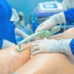 Enhanced Aesthetics: BodyTite Skin Tightening