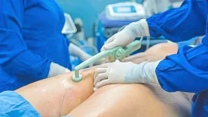 Enhanced Aesthetics: BodyTite Skin Tightening