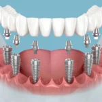 Post-Implant Care: Daily Oral-Rehab for All-on-6 Success