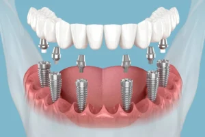 Post-Implant Care: Daily Oral-Rehab for All-on-6 Success