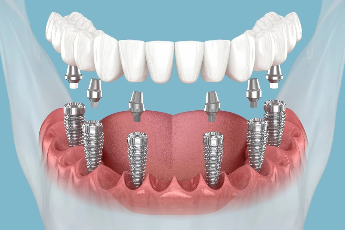 Post-Implant Care: Daily Oral-Rehab for All-on-6 Success